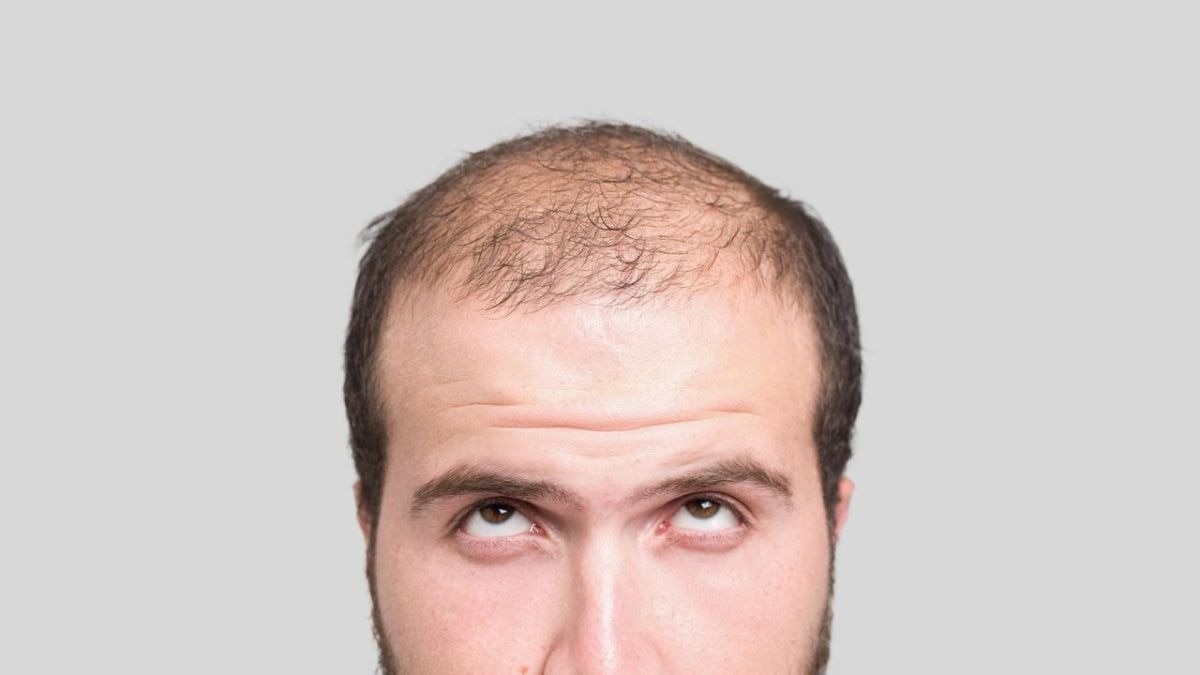 Bisakah pria yang melawan kerontokan rambut menumbuhkan kembali bagian yang botak dan garis rambut yang menyusut?