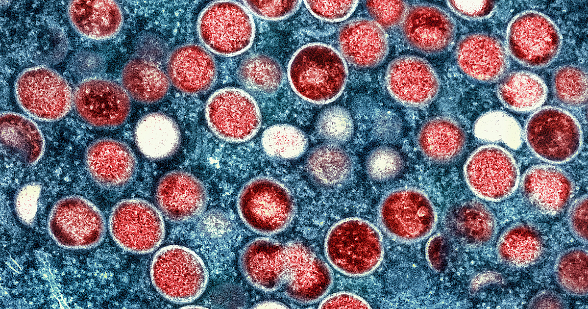 Satu kasus varian mpox baru dikonfirmasi di Eropa